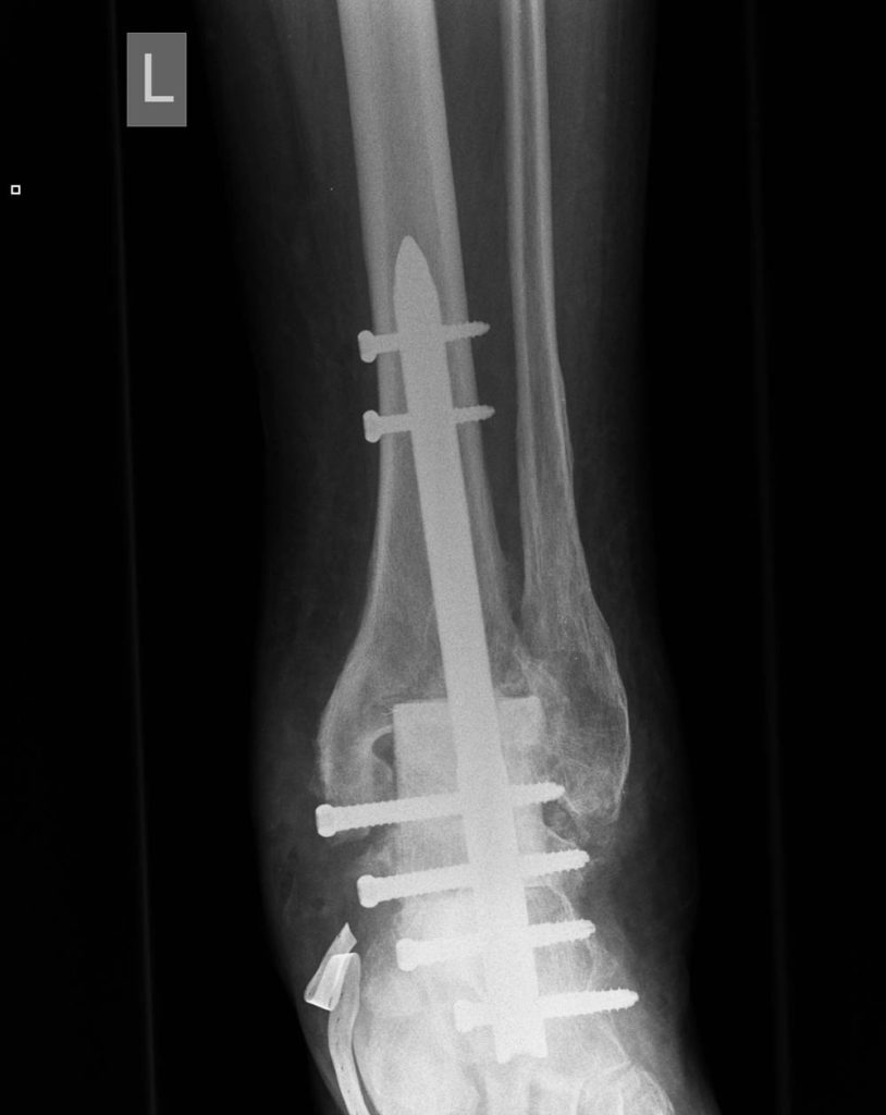 Nailing of the defective ankle joint
