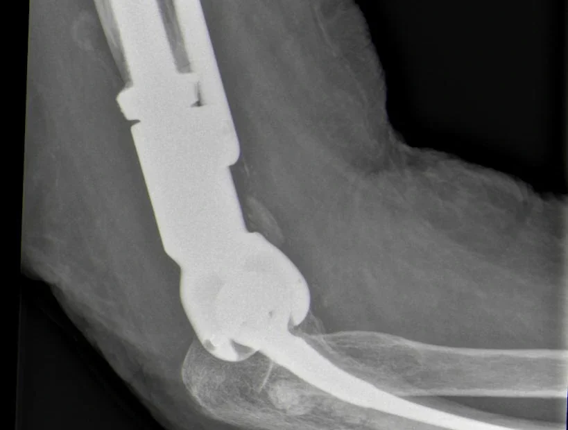 Artificial elbow joint